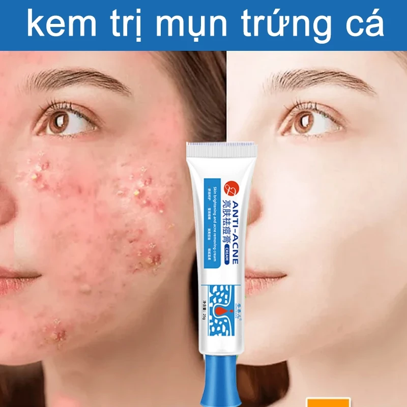 Kem chấm mụn cấp tốc 25g,Không kích thích,loại bỏ các loại mụn,mụn ẩn mụn đầu đen,mụn ở tuổi dậy thì,​loại bỏ