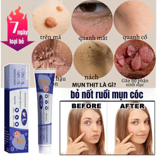 Kem Mụn Cóc Kem Tẩy Nốt Ruồi Mụn Cóc 20g 7 Ngày Loại Bỏ Nốt Ruồi Mụn Cóc Mụn Thịt Nhanh Chóng An Toàn Và Không đau