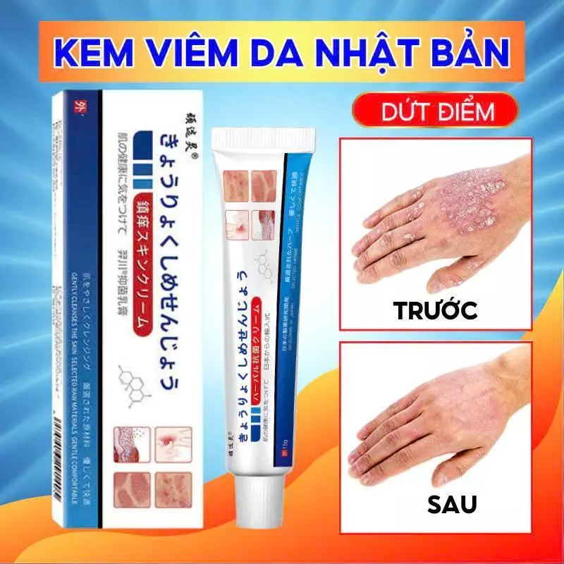 Combo 5 - 10 tuýp Kem Bôi Nấm Ngứa Viêm Da Cơ Địa NHẬT BẢN Hắc Lào, Tổ Đỉa, Vẩy Nến, Á Sừng, Lang Ben